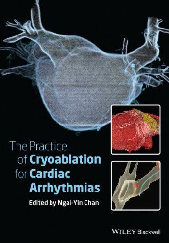 The Practice of Catheter Cryoablation for Cardiac Arrhythmias 2013
