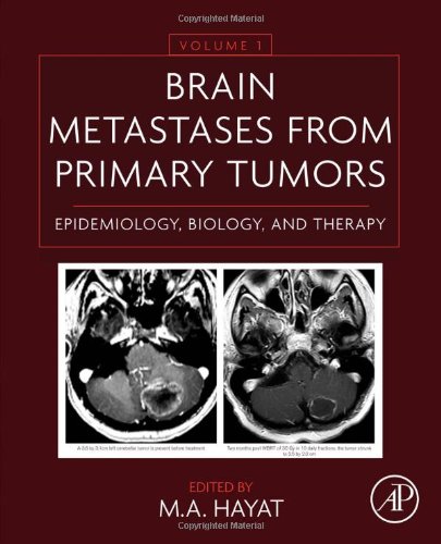 متاستازهای مغز از تومورهای اولیه جلد 1: اپیدمیولوژی، زیست شناسی و درمان