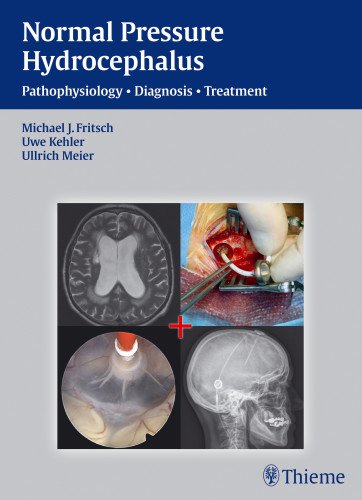 Normal Pressure Hydrocephalus: Pathophysiology, Diagnosis, Treatment 2014