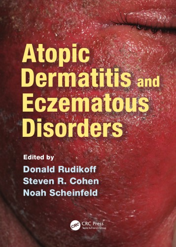 Atopic Dermatitis and Eczematous Disorders 2014