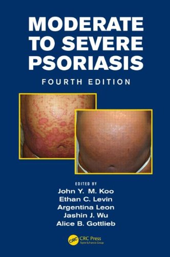 Moderate to Severe Psoriasis, Fourth Edition 2014