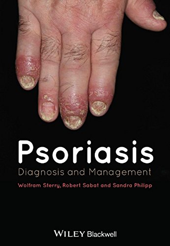Psoriasis: Diagnosis and Management 2014