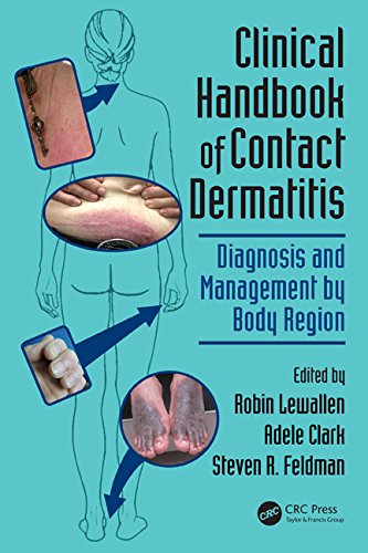Clinical Handbook of Contact Dermatitis: Diagnosis and Management by Body Region 2014