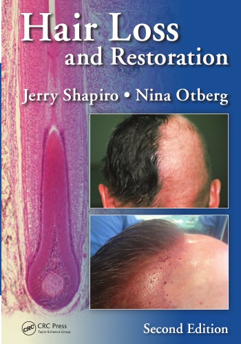 Hair Loss and Restoration, Second Edition 2015