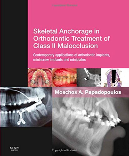 Skeletal Anchorage in Orthodontic Treatment of Class II Malocclusion: Contemporary Applications of Orthodontic Implants, Miniscrew Implants and Mini Plates 2014