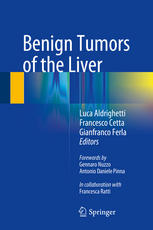 Benign Tumors of the Liver 2015