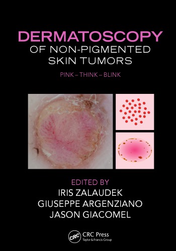 Dermatoscopy of Non-Pigmented Skin Tumors: Pink - Think - Blink 2016