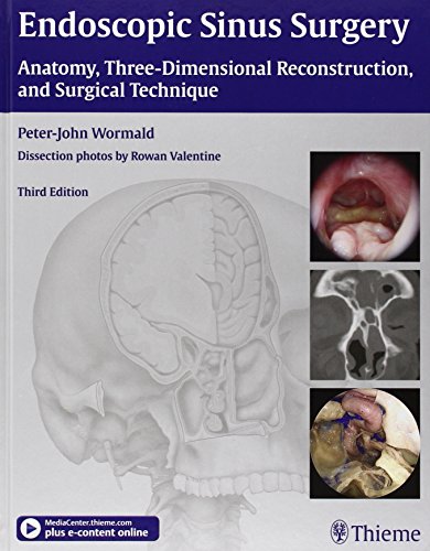 Endoscopic Sinus Surgery: Anatomy, Three-dimensional Reconstruction, and Surgical Technique 2012