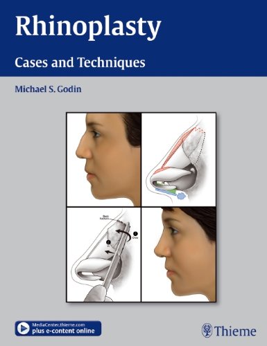 Rhinoplasty: Cases and Techniques 2011