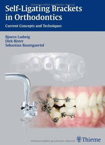 Self-ligating Brackets in Orthodontics: Current Concepts and Techniques 2012