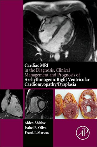 Cardiac MRI in Diagnosis, Clinical Management, and Prognosis of Arrhythmogenic Right Ventricular Cardiomyopathy/Dysplasia 2016
