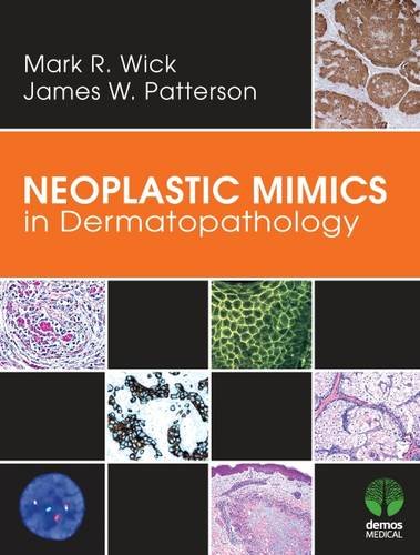 Neoplastic Mimics in Dermatopathology 2013