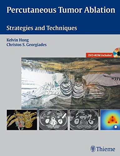 Percutaneous Tumor Ablation: Strategies and Techniques 2011