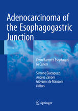 Adenocarcinoma of the Esophagogastric Junction: From Barrett's Esophagus to Cancer 2017