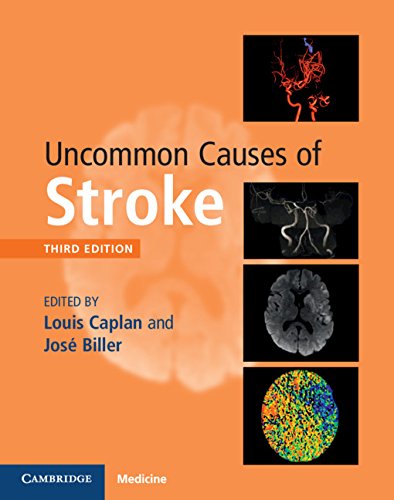 Uncommon Causes of Stroke 2018