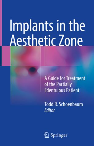 Implants in the Aesthetic Zone: A Guide for Treatment of the Partially Edentulous Patient 2018