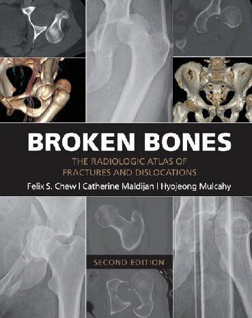Broken Bones 2016