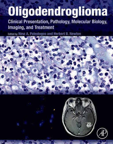 Oligodendroglioma: Clinical Presentation, Pathology, Molecular Biology, Imaging, and Treatment 2019