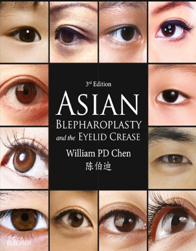 Asian Blepharoplasty and the Eyelid Crease E-Book 2015