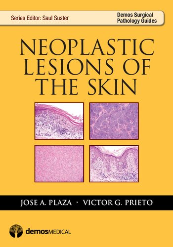 Neoplastic Lesions of the Skin 2013