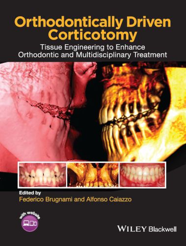 Orthodontically Driven Corticotomy: Tissue Engineering to Enhance Orthodontic and Multidisciplinary Treatment 2014