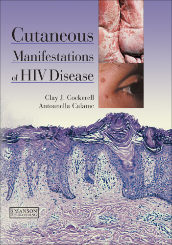 Cutaneous Manifestations of HIV Disease 2012