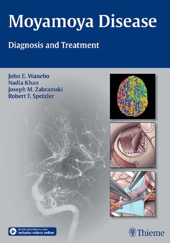 Moyamoya Disease: Diagnosis and Treatment 2013