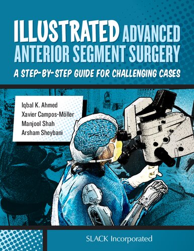 Illustrated Advanced Anterior Segment Surgery: A Step-By-Step Guide for Challenging Cases 2021
