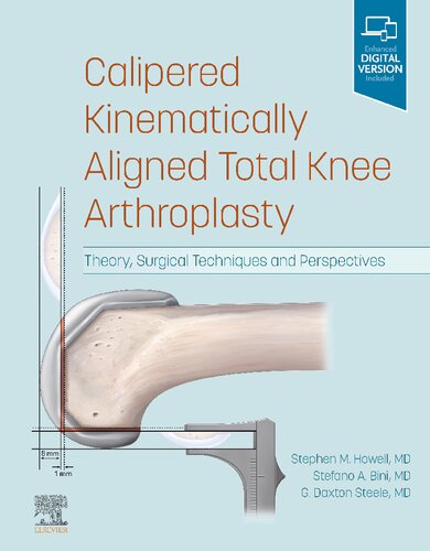 Calipered Kinematically Aligned Total Knee Arthroplasty: Theory, Surgical Techniques and Perspectives 2021