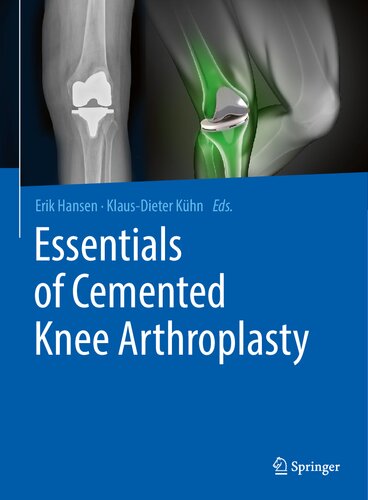 Essentials of Cemented Knee Arthroplasty 2021
