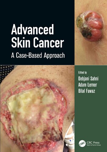 Advanced Skin Cancer: A Case-Based Approach 2022