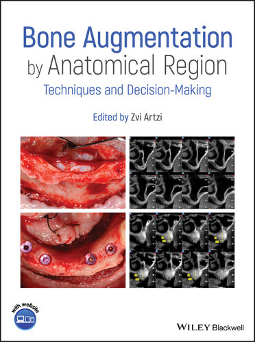 Bone Augmentation by Anatomical Region: Techniques and Decision-Making 2020