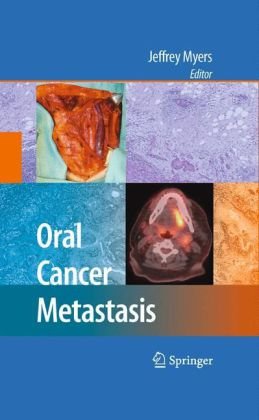 Oral Cancer Metastasis 2009