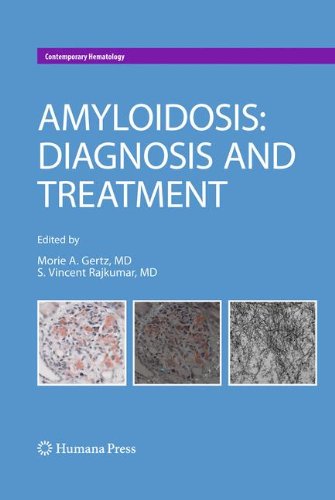 آمیلوئیدوز: تشخیص و درمان