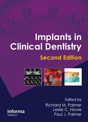 Implants in Clinical Dentistry, Second Edition 2011