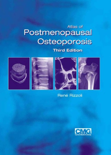 Atlas of Postmenopausal Osteoporosis: Third Edition 2011