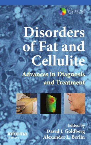 Disorders of Fat and Cellulite: Advances in Diagnosis and Treatment 2011