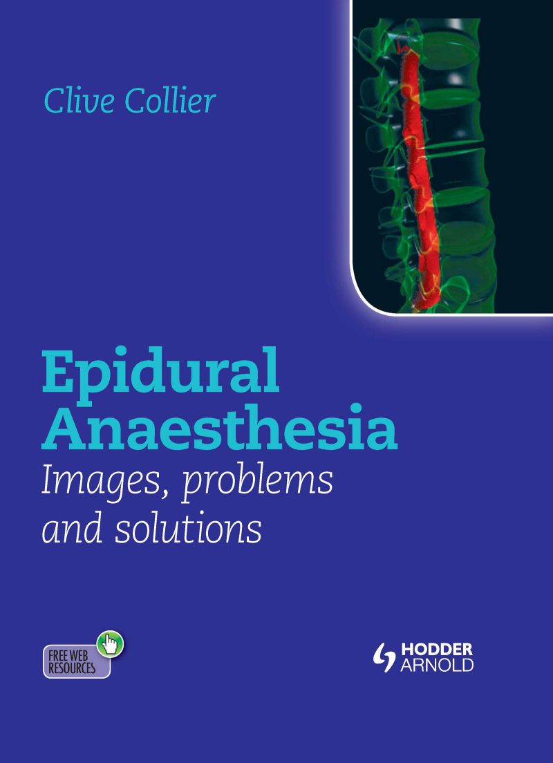 بیهوشی اپیدورال: تصاویر، مشکلات و راه حل ها ۲۰۱۲